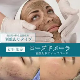 【4/17まで限定❗️】剥離ありハーブピーリング🌿5日間の集中肌管理✨ニキビ/ニキビ跡/凹凸/シミなど頑固な肌悩みに◎