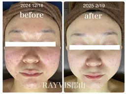 マスクでの肌荒れ 繰り返しできるニキビ…🥲一緒に改善していきましょう❗️