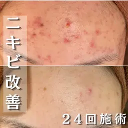 【😫繰り返しニキビもニキビ跡も😫】ダウンタイム無しで確実に治す！脱ニキビ肌コース！ピーリング+W鎮静パック