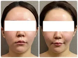 エステ通常価格【ボトックス検討中の方！】改善凝り固まったエラ頬を撃退80分【¥18,700→¥8800】