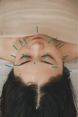 【小顔になりながら肩こり、むくみも楽に✨】顔＋全身美容鍼灸コース