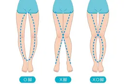 O脚矯正