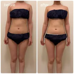 結果重視の痩身！ハイパーナイフ全身60分