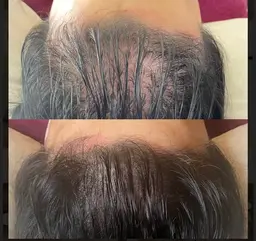 頭皮が薄い方で育毛、発毛に興味ある方医療グレードLit　シャンプーブロー込み