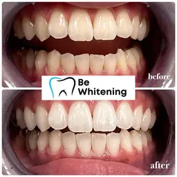 🥇人気No.1🥇まずはお試し【️ 15分照射×2回】セルフホワイトニング¥8800→¥3300(1日完結)