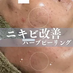 【ニキビ・毛穴改善】剥けないハーブピーリング＋選べる美肌オプション1種＋ipsp幹細胞仕上げ　定価18,150円