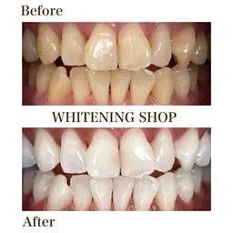 【新規のみ】当店初回セルフホワイトニング40分 1,980円