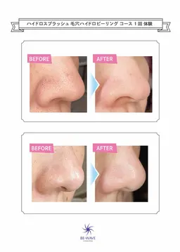 ハイドロピーリング☆毛穴洗浄