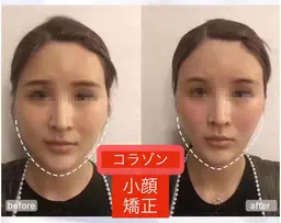 頭蓋骨小顔矯正