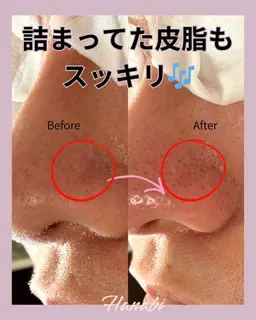 【毛穴・黒ずみ・皮脂詰まり】毛穴エクストラクションプロで根本から除去！一度でつるんと透明感ある肌へ導きます！