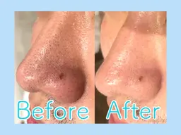 メンズ☆黒ずみ毛穴洗浄