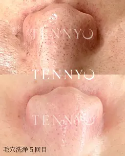 最新【毛穴洗浄モニター様】頑固な角栓や皮脂に！肌負担なしだからこそキレイなお肌へ導きます✨️敏感肌対応！