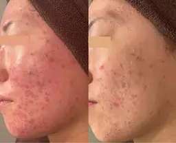 剥離なしハーブピーリング※剥離ありを希望の方はご相談ください