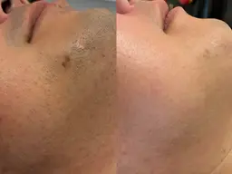 【メンズ髭脱毛】 REVI美肌脱毛