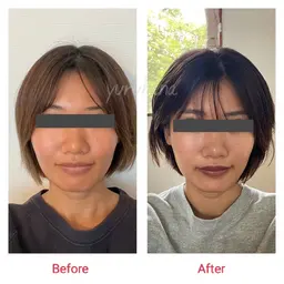 極上リフトアップ《人気No.1❤️リフトアップ／目ヂカラup／ほうれい線／ヘッドスパ》小顔矯正とヘッドコース（60分）