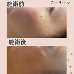 ニキビ　敏感肌の悩みの方　有機玄米の酵素パックで肌質改善