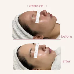 🌸4月限定🌸ラミピール×LDM◇次世代ピーリング|剥離なし｜ララピール｜毛穴｜くすみ｜ニキビ｜シワ