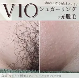 1回でツルツルもち肌に✨シュガーリングVIO脱毛✨お肌に優しいワックス脱毛☺️京都初💎mix脱毛も可