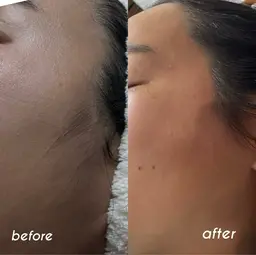 【初回限定】フェイシャルワックス〈顔のみ〉45分｜¥7,000