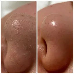 とことん毛穴洗浄！とリラックスエステ