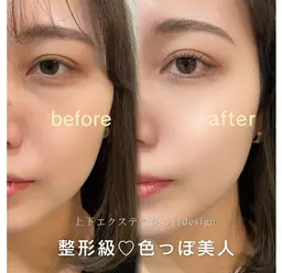 下まつげエクステ🍸✴︎片目10本​〜​（計20本）  | エクステmenuとの併用🆗◎［＋片目5本ずつ増で¥550​〜​］