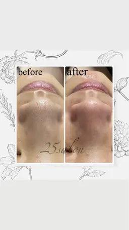 【限定クーポン】ハイドラフェイシャル💆🏼‍♀️🌿(毛穴洗浄) 美容液+パック付き🌈ᵕ̈*