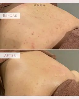 【背中上半】ニキビ/ザラツキ　毛穴洗浄