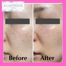 【クリスティーナ💙イラストリアス】❄️シミ・美白ピーリング・黒ずみ毛穴レス🫧¥24,200⇒¥12,000