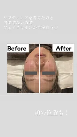 【小顔/リフトアップ】スッキリ上向きリフトアップ
