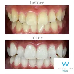 【初めての方】レディース割★セルフホワイトニング新規様限定1セット(40分)¥6980→¥2500※口コミ条件