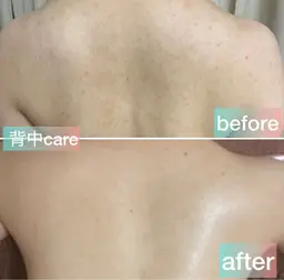 【背中ニキビ・ザラつき撃退✨】広範囲フル洗浄/角質ケア＆こりほぐし付 （大阪 梅田）