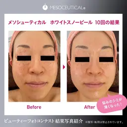 【1日2名限定SPメニュー】小顔×毛穴洗浄⭐️白玉肌ホワイトスノーピーリング/ダウンタイム無/シミくすみシワたるみに◎