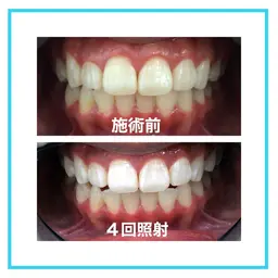 ✨ご新規様minimo限定✨歯のセルフホワイトニング８分×4回照射　(施術時間60分)