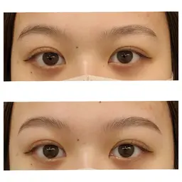 ハリウッドブロウリフト