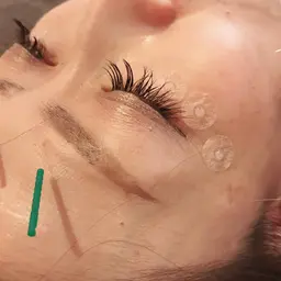 美容鍼のみ(目元コース)