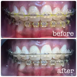 ✨ホワイトニング✨ナチュラルホワイトニング8分×2照射🦷🪥