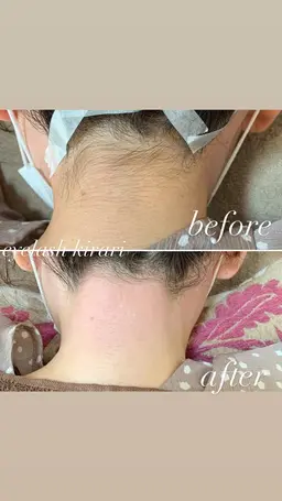 アップスタイルで後ろ姿美人♡うなじwax脱毛👳‍♀️✨