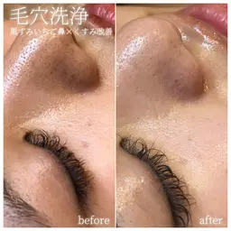 毛穴洗浄👃特殊なローションでしっかり汚れを浮き出して絡めとる🧼✨浮き出しポツポツ汚れ/黒ずみ毛穴/一切にスッキリ😎