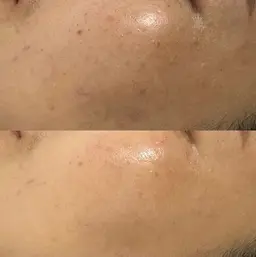 韓国NO1人気🇰🇷ララピール進化版✨渡韓無しで◎セラピール◎毛穴/美白/くすみ/ニキビ（セラ洗顔＋セラピール＋保湿）