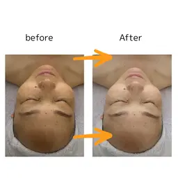 美白透明感アップ⤴️ホワイトニングコース