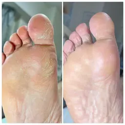 🦶韓国式足裏角質ケア🦶🥳エスプランニング👍🏻❤️古い角質ごっそり取れて赤ちゃんの足裏へ👶