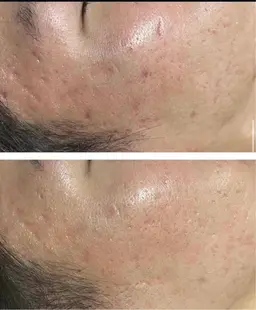 【剥離なし】顔🌿ハーブピーリング