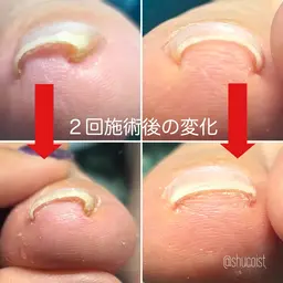 【3回コース】巻き爪ケア【メンズOK◎】