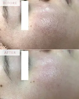 【年末SALE❤️‍🔥】リピーター続出❗️剥離なしピーリングで磨き上げる素肌美✨初回¥11,000→¥7000