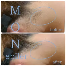 うなじワックス脱毛