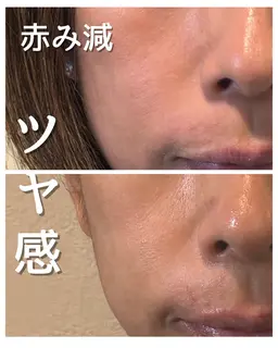 ハリ実感✨フェイシャル　チェアエステ　90分