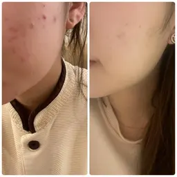 人気No.1【毛穴ごっそり×肌質改善】ニキビ・毛穴ケアフェイシャル💆‍♀️60分《¥6,600》