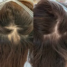 プロセルセラピーズ‐頭皮トリートメント‐※モニター様