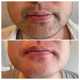 メンズWax脱毛ヒゲ全体