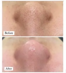 毛穴エクストラクション×クリスティーナ肌質別栄養マスク+ヘッドマッサージ付　¥11500→¥7100